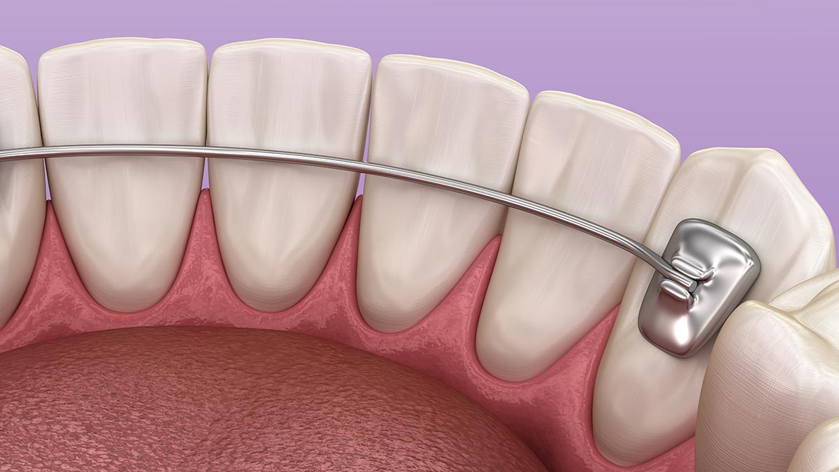 Commonly Asked Questions About Tooth Jewelry - Aces Braces