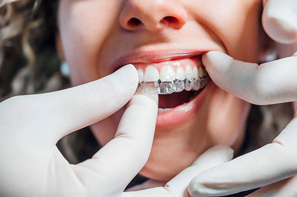 Invisalign Is Effective for Less Complex Orthodontic Cases from Aces Braces in Brooklyn, NY