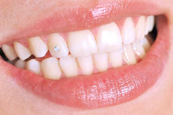 Commonly Asked Questions About Tooth Jewelry - Aces Braces Brooklyn New York