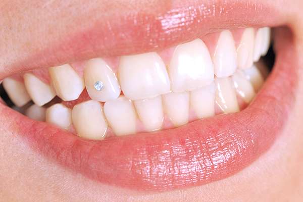 Commonly Asked Questions About Tooth Jewelry - Aces Braces